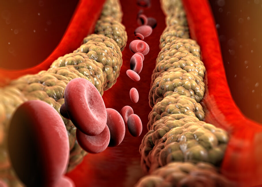 Akumulacija kolesterola unutar arterija ih sužava i začepljuje, što otežava prolaz krvi kroz njih.