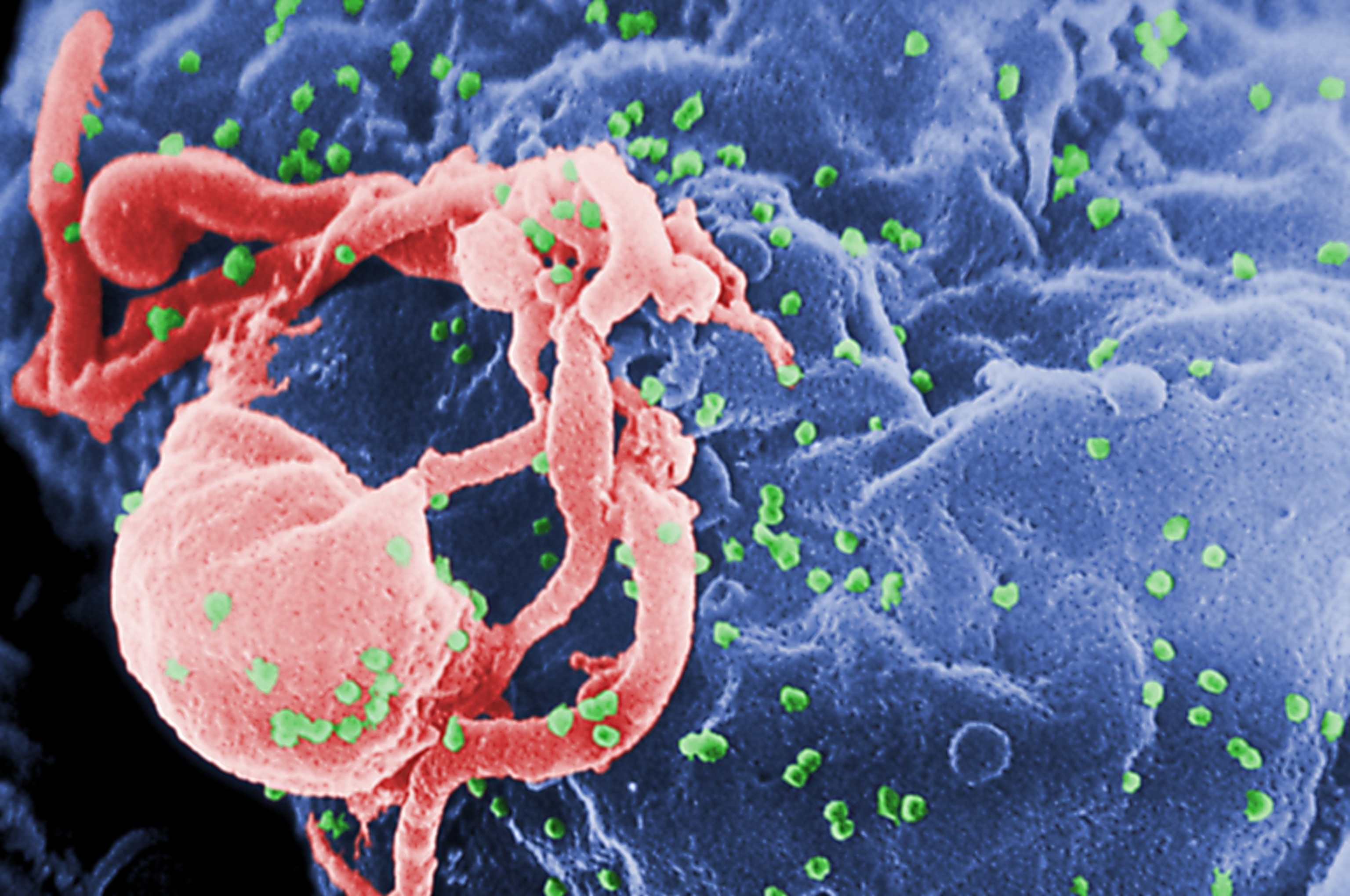 FOTOGRAFIJA: Na ovoj fotografiji iz datoteke iz 1985. skenirani elektronski mikrograf (SEM) prikazuje virione HIV-1 kao zelene okrugle izbočine koje pupaju s površine kultivirane stanice limfocita.